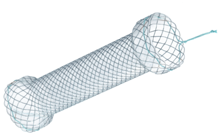 Niti-S™ Esophageal Double Anti Migration Distal Release Stent