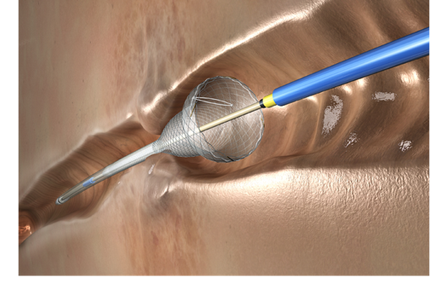 Niti-S™ Esophageal Double Anti Migration Proximal Release Stent